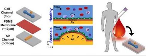 在芯片上實現動脈粥樣硬化的模擬，并在心臟病發作前評估血管的狹窄和血液的健康狀況