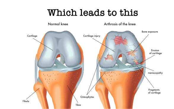 微流控“軟骨”芯片（Knee On Chip）用于關節炎研究